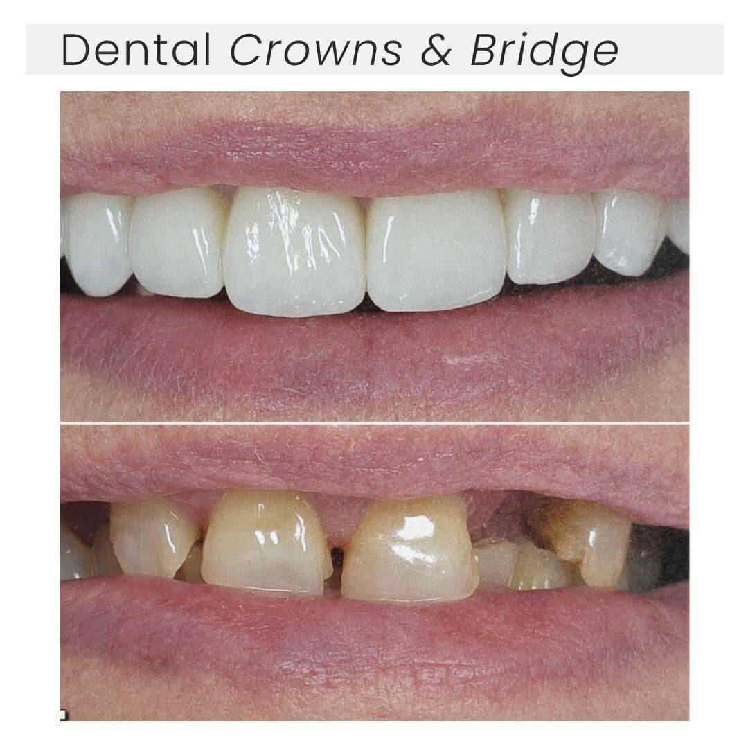 before and after