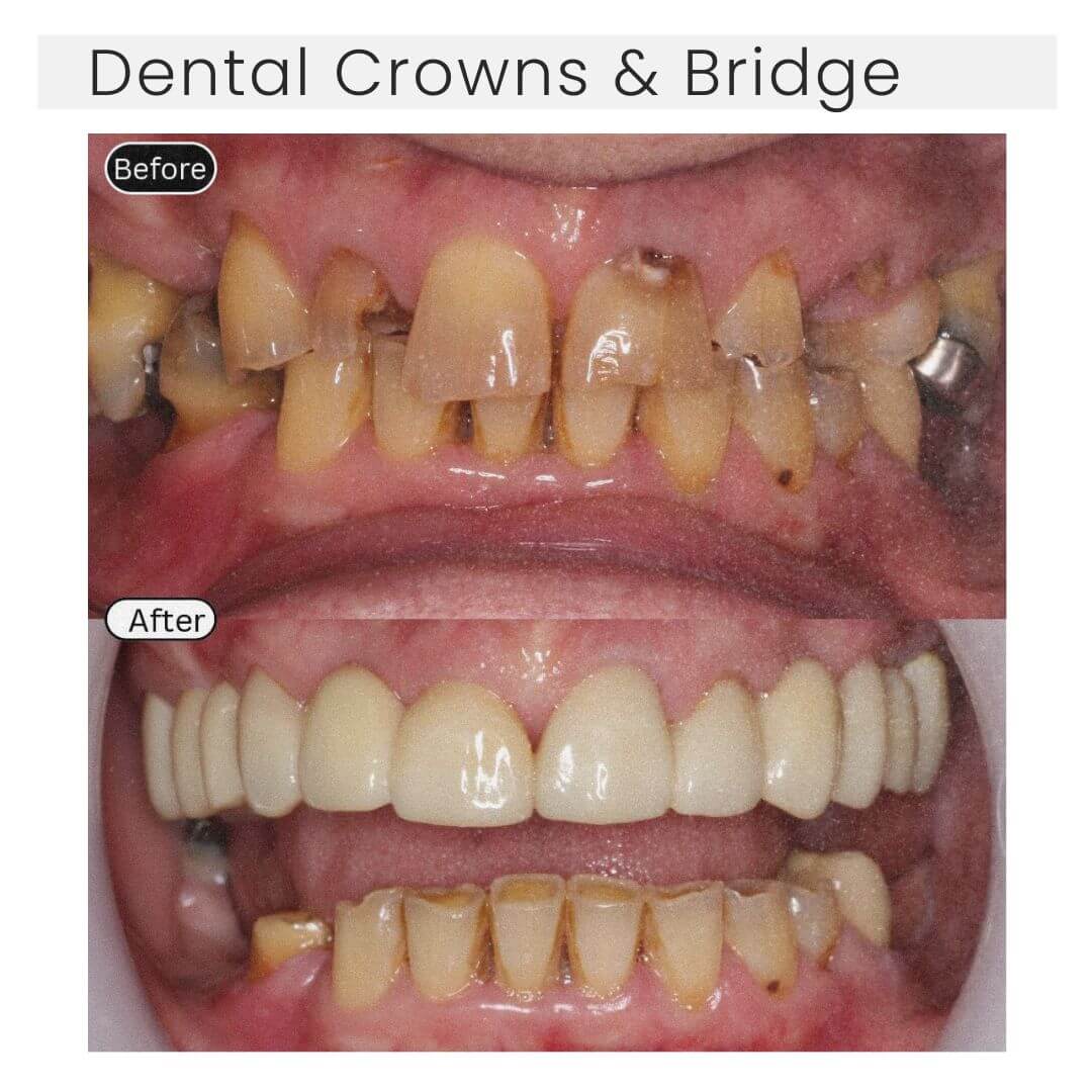 before and after