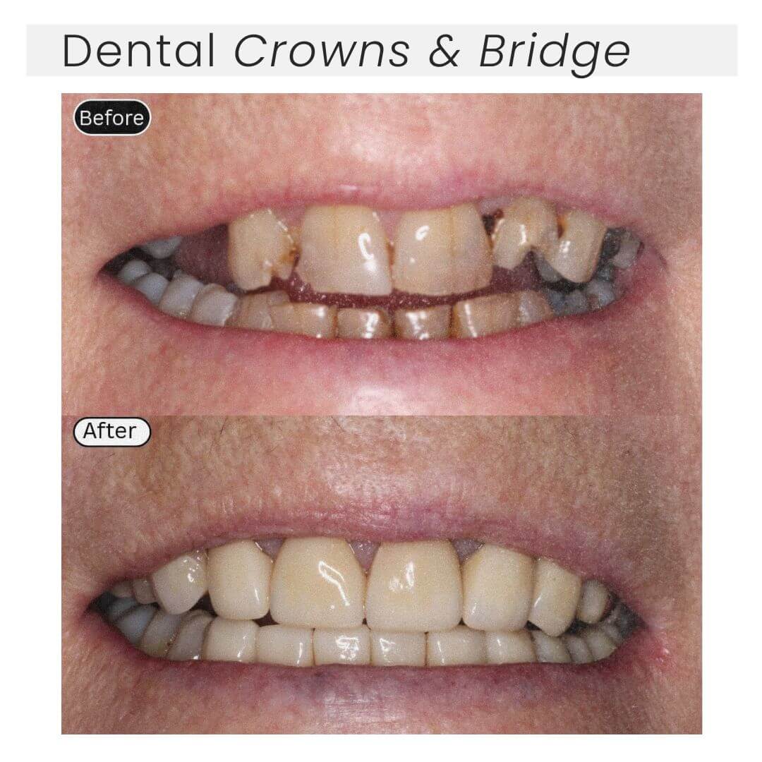 before and after