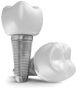 dental implants