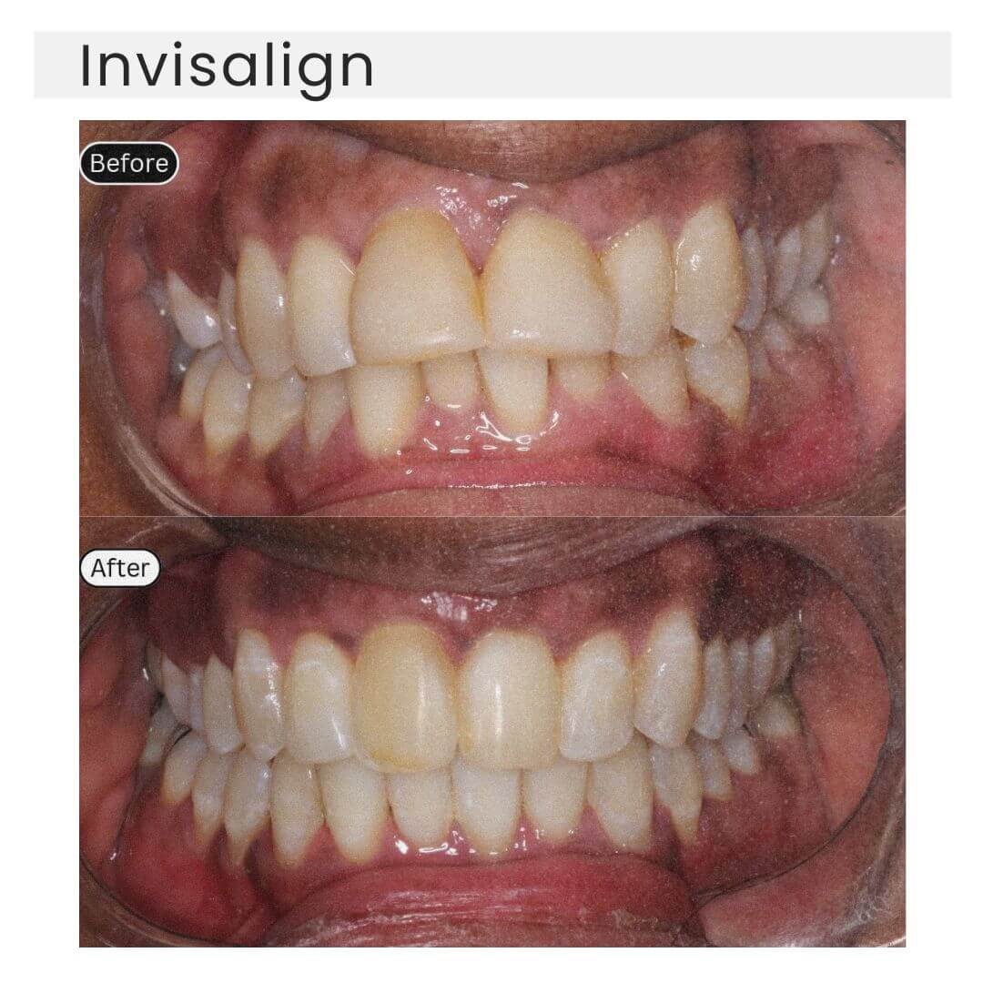 before and after