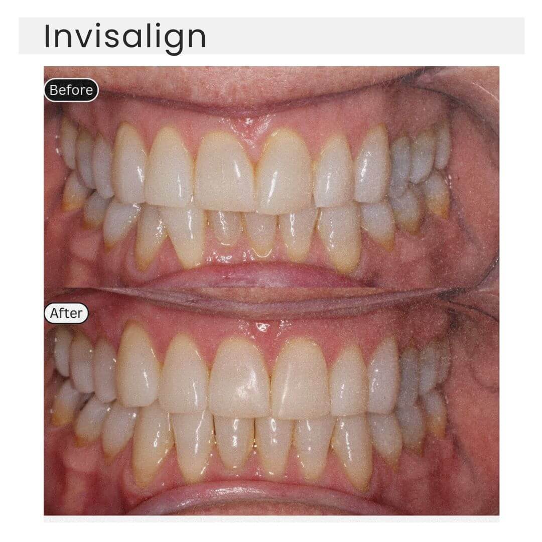 before and after