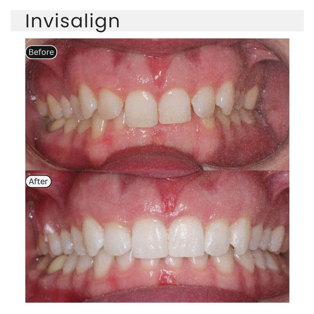 before and after