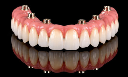 Implant Dentures
