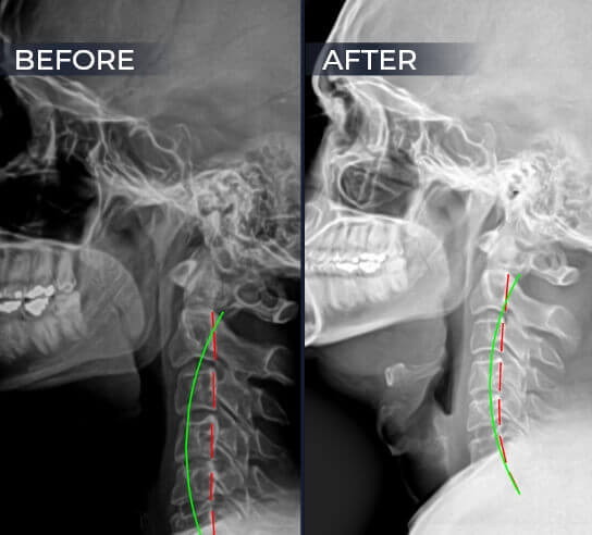 xray before and after