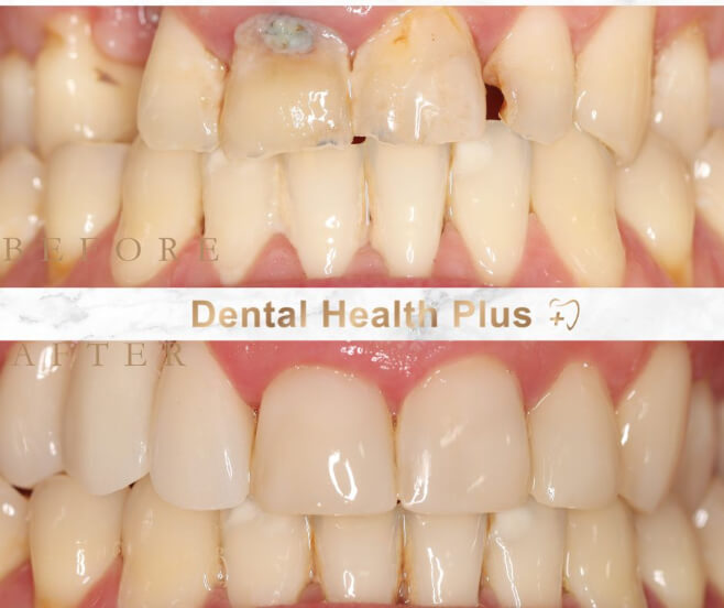 Composite Bonding and Bridge before and after