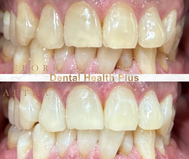 Results of teeth whitening