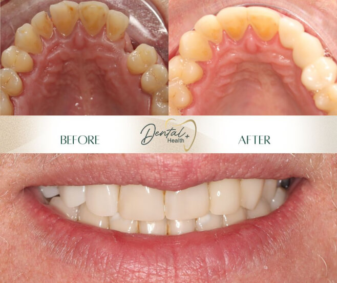 composite bonding and bridge graphic