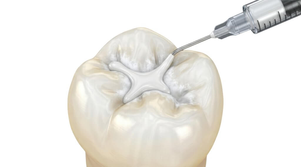 dental filling illustration