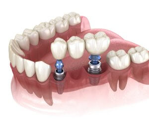 implant supported bridge