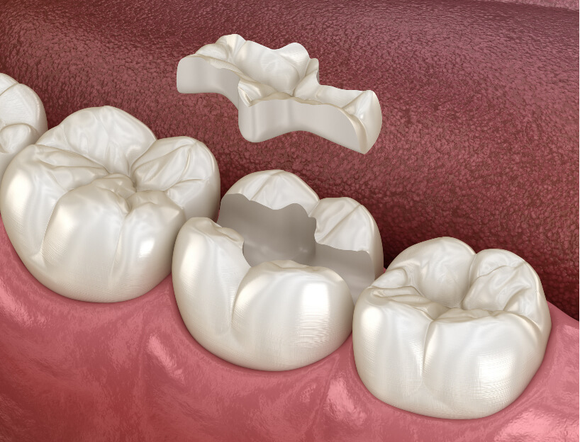 Inlays and onlays illustration