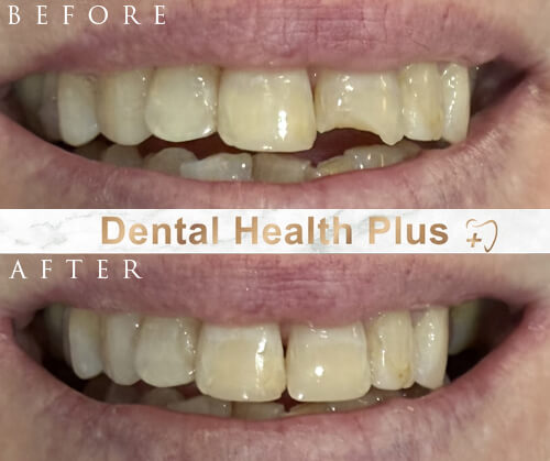 invisalign before and after