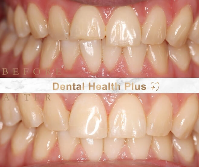 jp-composite-bonding before and after