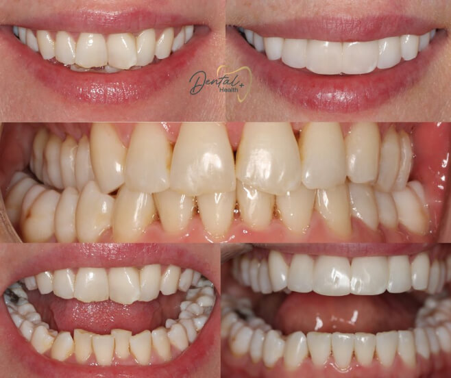kl-invisalign-composite-bonding-bioclear before and after