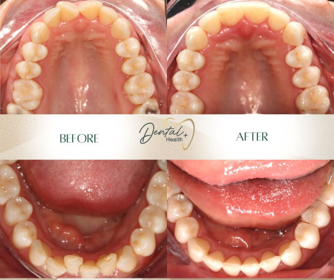 kl-occlusal before and after