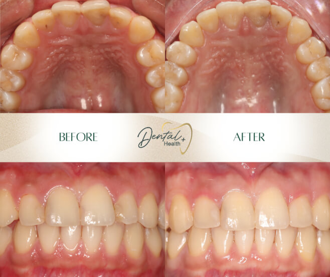 ls-invisalign-occlusal before and after
