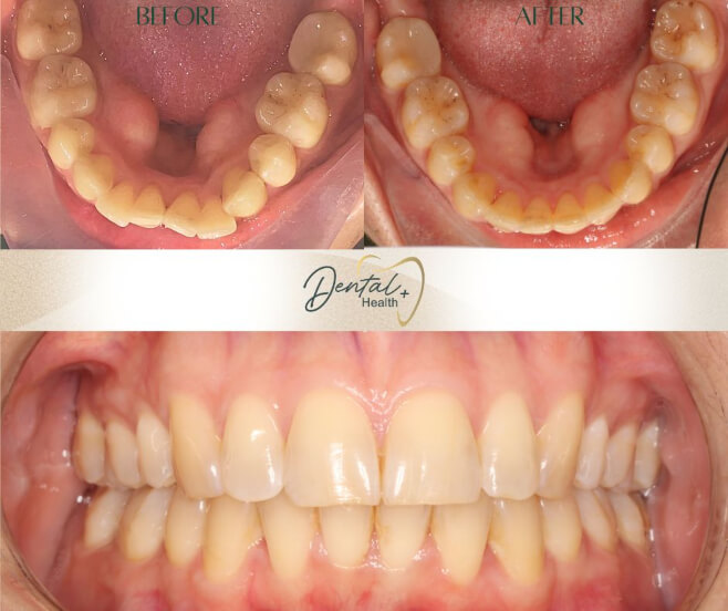 ml-invisalign before and after