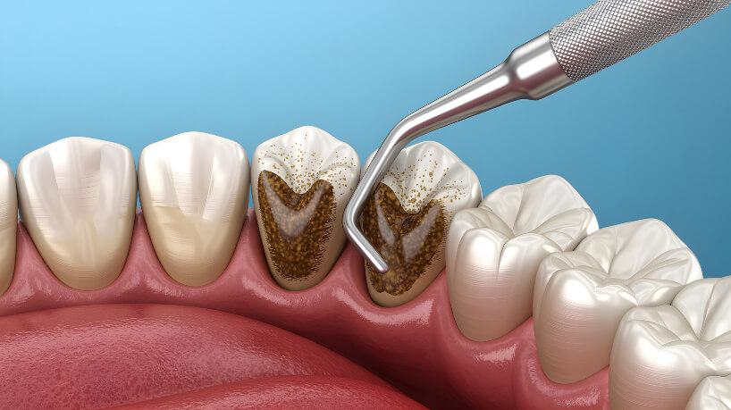 Periodontal illustration