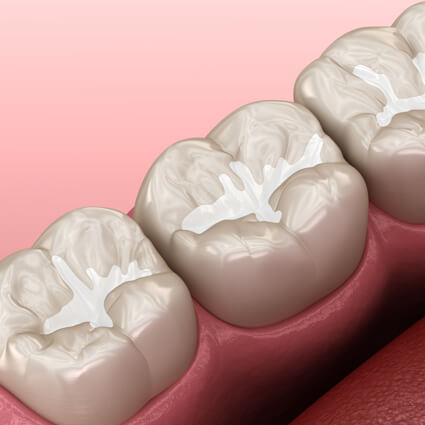 Sealants model