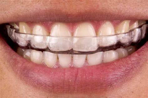 Smile with mouthguard