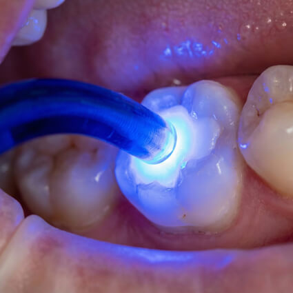 tooth filling