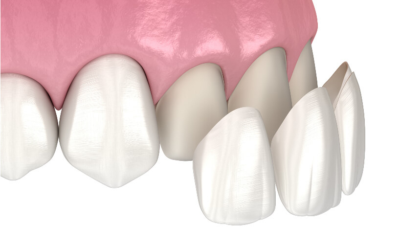 dental veneer teeth illustration