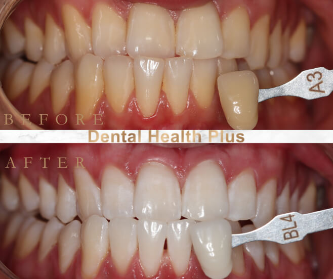 Teeth whitening before and after