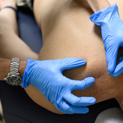 dry needling on shoulder
