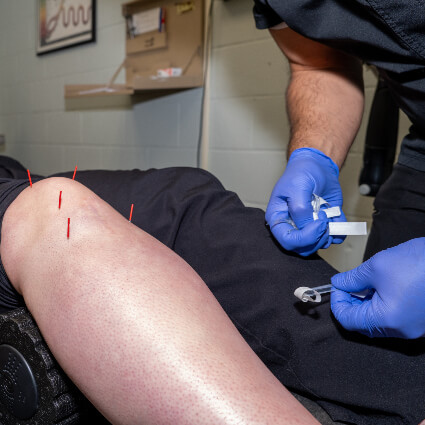 Applying acupuncture needles