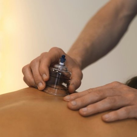 Cupping therapy is being performed on someone's back