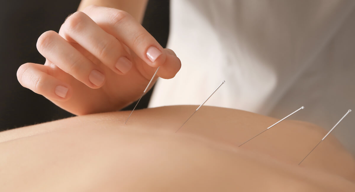 Close-up view of acupuncture treatment