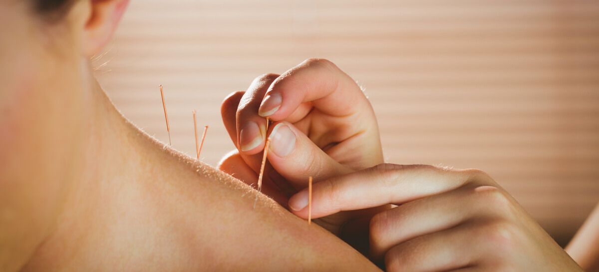 Dry Needling used to treat patient