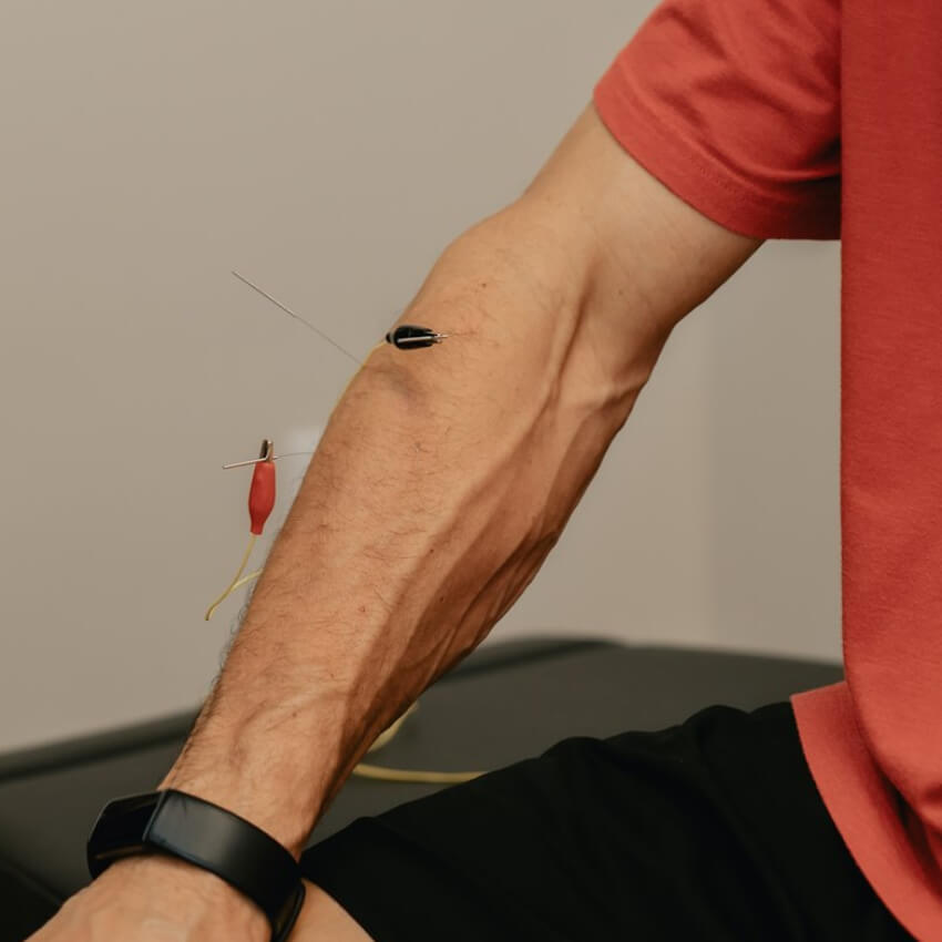 Practitioner administering electro-acupuncture on a patients arm for nerve pain relief