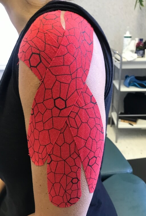 Kinesio taping used on patient's shoulders