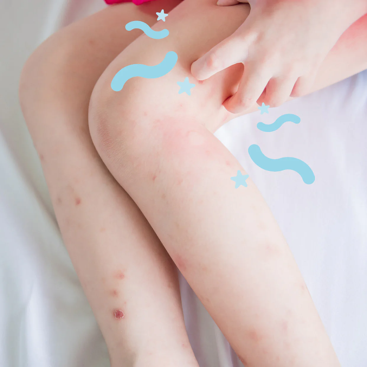 eczema