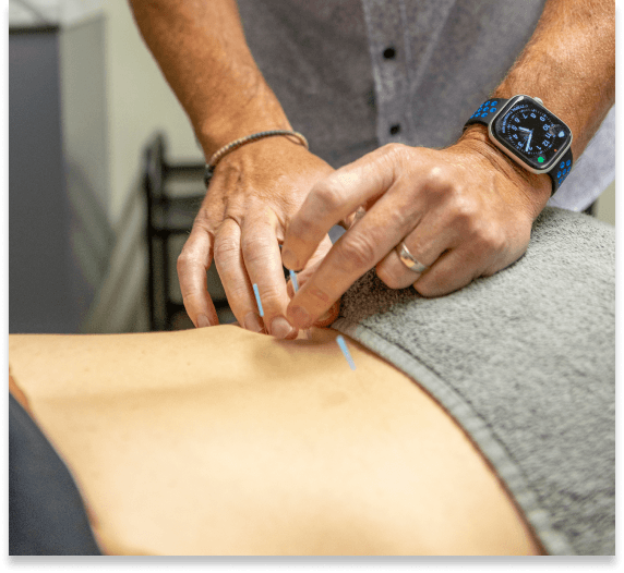 Key City Chiropractic & Acupuncture patient having acupuncture treatment on their lower back