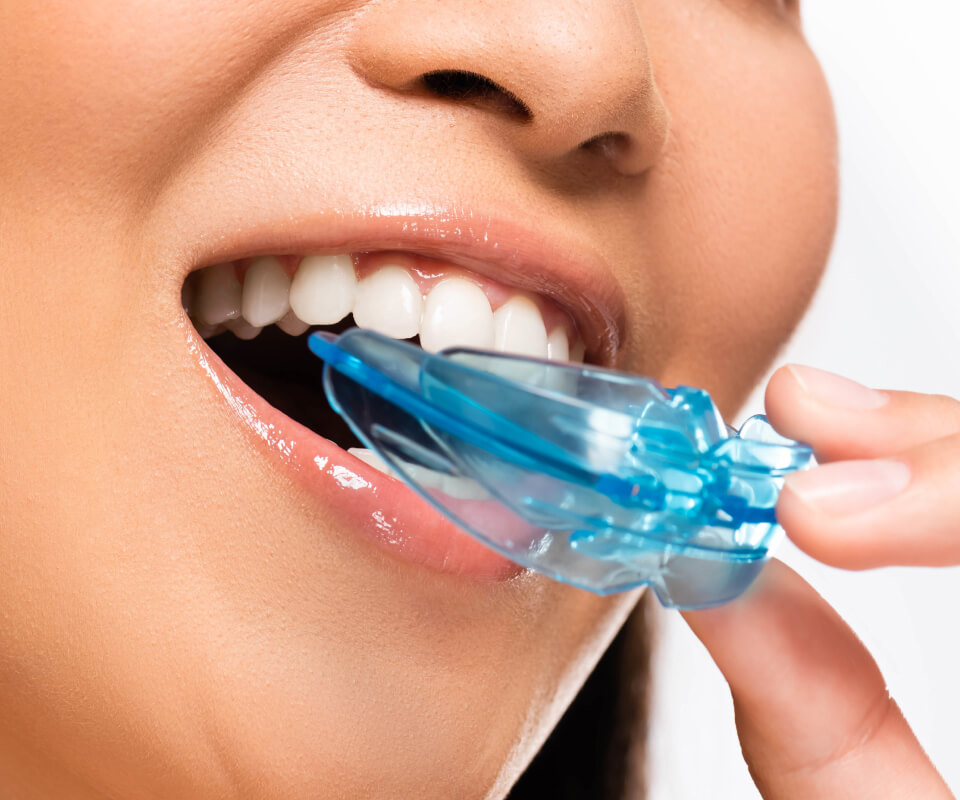 Woman placing a mouthguard inside her mouth
