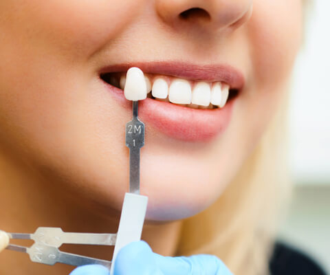 Female patient fitting veneers