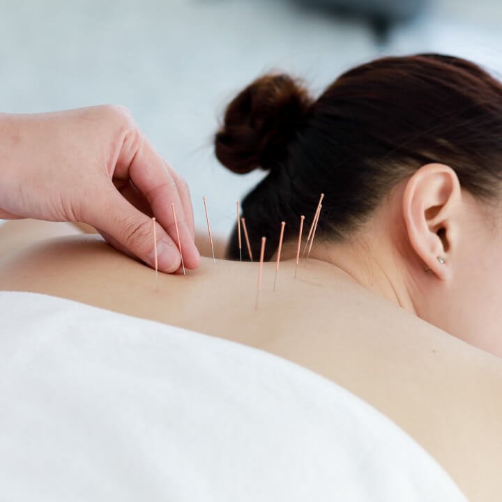 Acupuncture needles on back