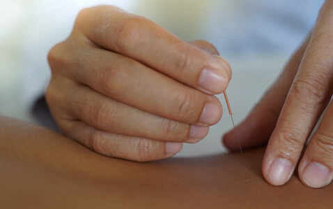 Patient treated with Acupuncture
