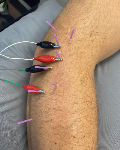 needling on elbow