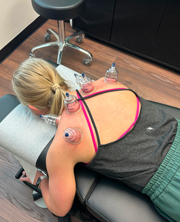 woman getting cupping treatment