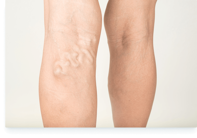 varicose veins on the back of a person's legs