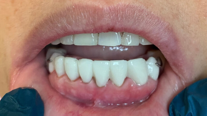 After dental bridge treatment