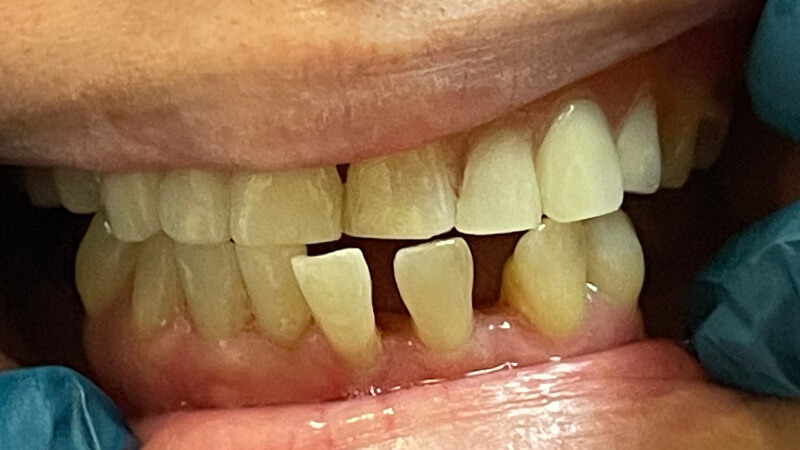 Before dental bridge treatment