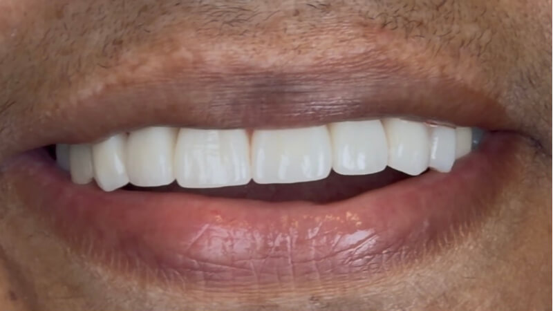 After treatment