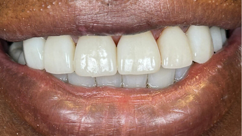 After treatment