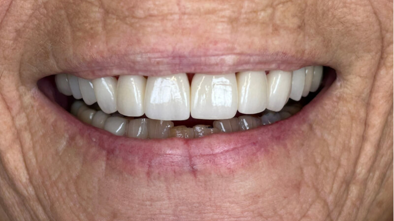 After treatment