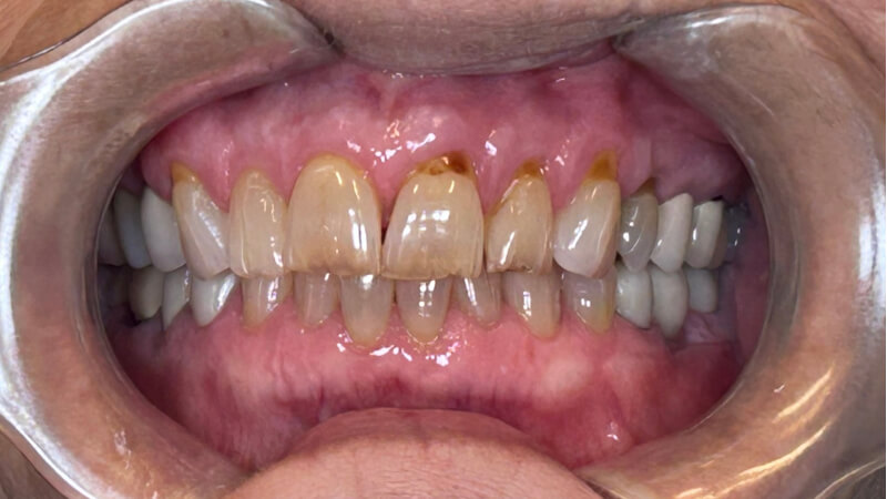 Before treatment