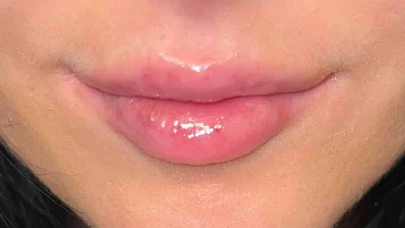 After dental bridge treatment